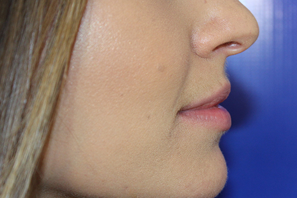 before filler female patient side view case 3305