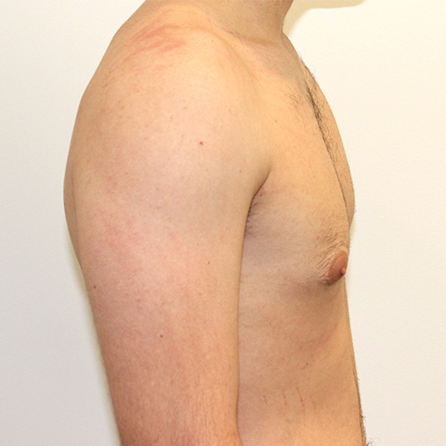 After gynecomastia surgery side view case 3351