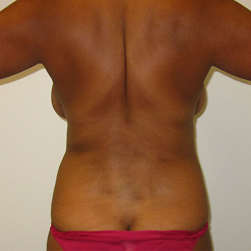 before liposuction back view case 3354