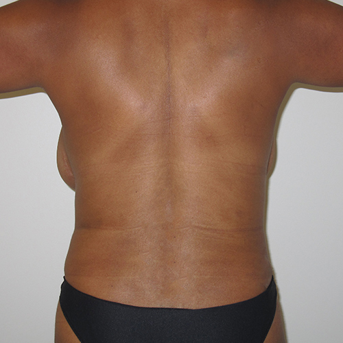 after liposuction back view case 3354