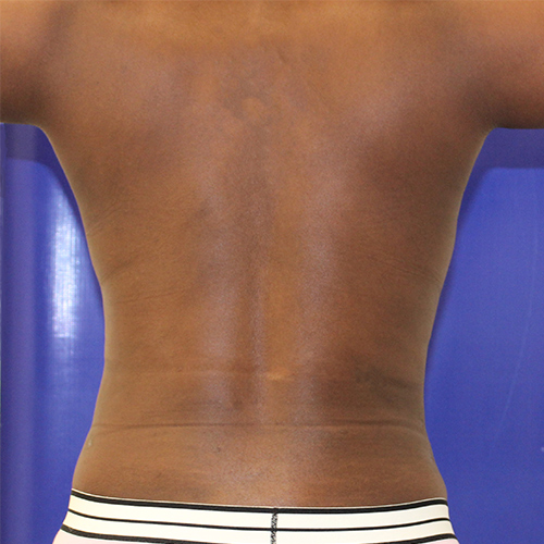 after liposuction back view case 3357