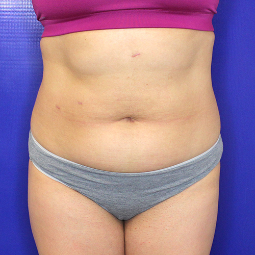 before liposuction stomach female patient front view case 3360