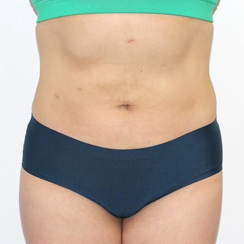 after liposuction stomach female patient front view case 3360