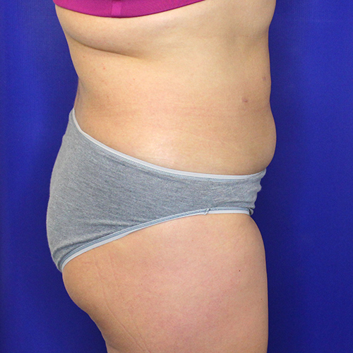 before liposuction stomach female patient side view case 3360