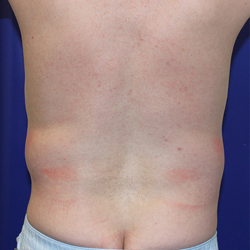 before liposuction back male patient front view case 3335