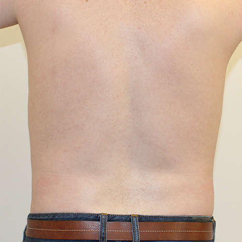 after liposuction back male patient front view case 3335