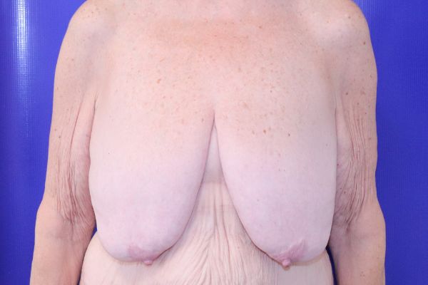 before Breast reduction Female Patient front View Case 3597