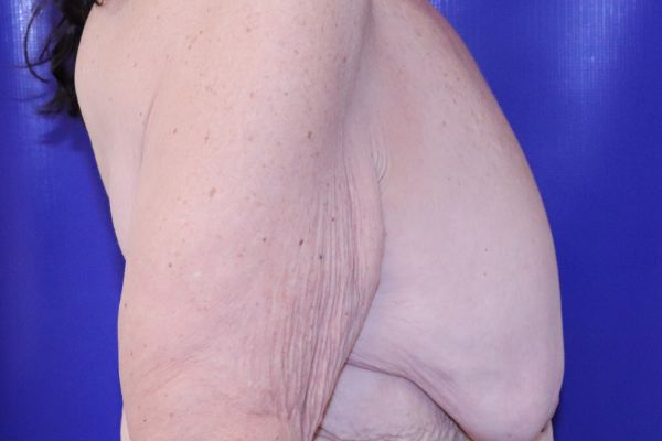 before Breast reduction Female Patient right View Case 3597