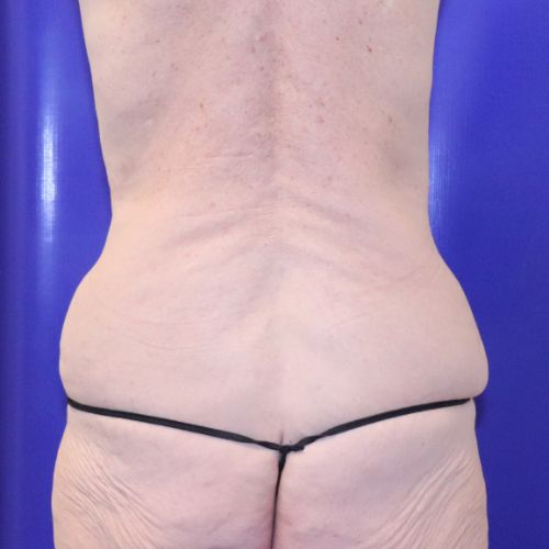 before halo lift back view female patient case 3582