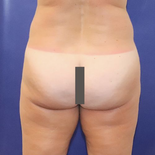 before halo lift back view female patient case 3590