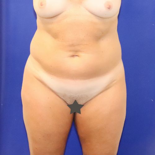 before halo lift front view female patient case 3590