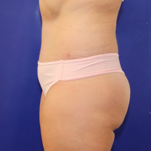 after halo lift left view female patient case 3590