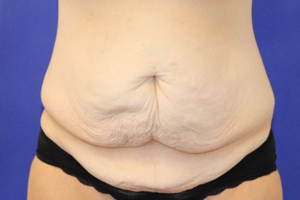 before circumferential abdominoplasty front view female patient case 3864