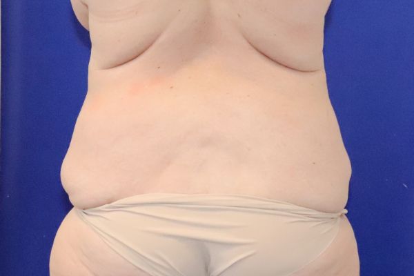 before circumferential abdominoplasty back view female patient case 4554
