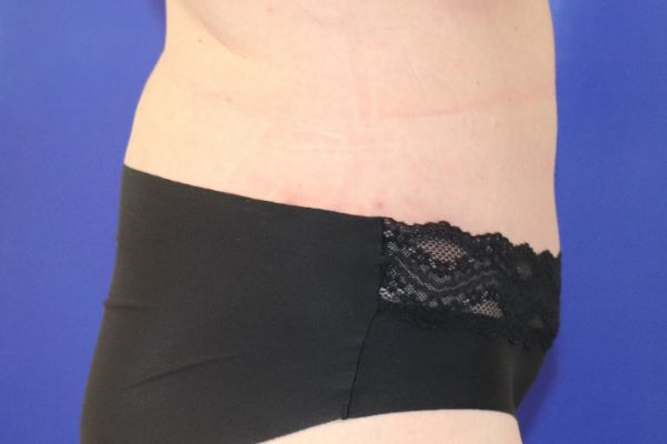 after circumferential abdominoplasty right view female patient case 4554