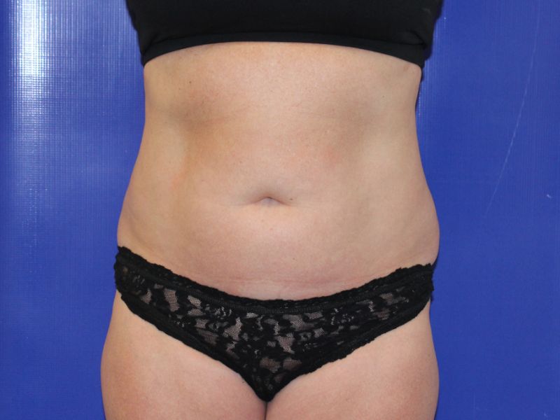 before halo lift front view female patient case 4538