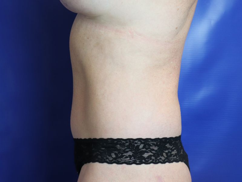 after halo lift left view female patient case 4538