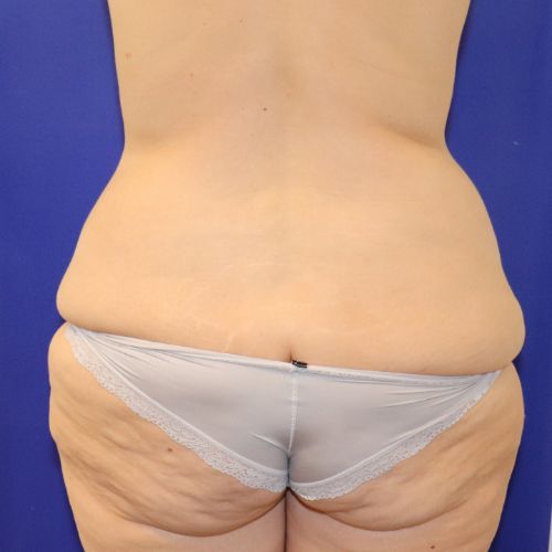 before halo lift back view female patient case 4545