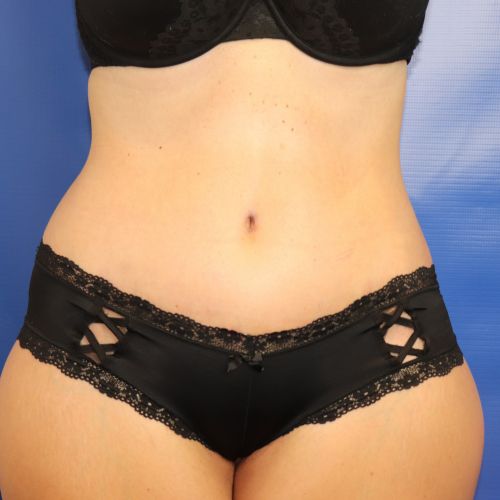 after halo lift front view female patient case 4545