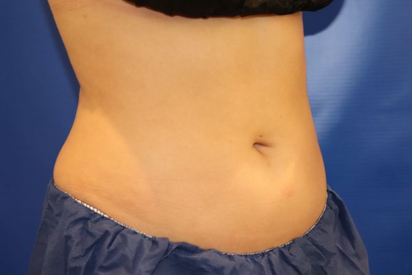 before cooltone front view female patient case 4606