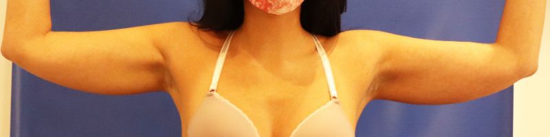 before cooltone front view female patient case 4609