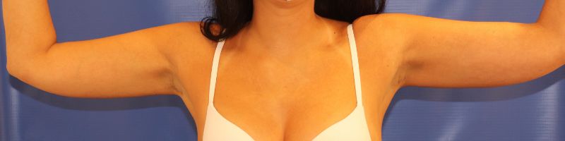 after cooltone front view female patient case 4609