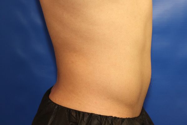 after cooltone right view male patient case 4615