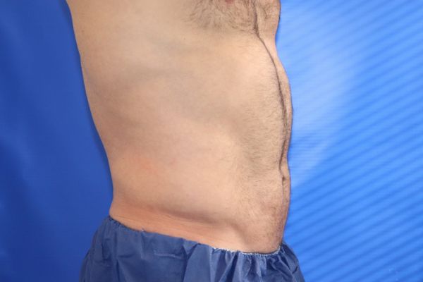 before cooltone right view male patient case 4621