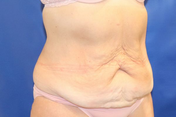 before circumferential abdominoplasty right angle view female patient case 4649