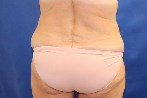 before circumferential abdominoplasty back view female patient case 4649
