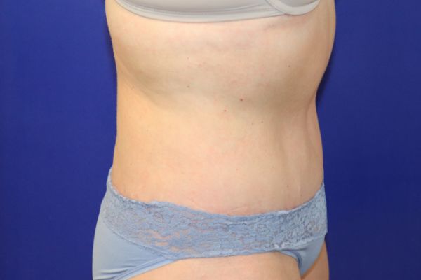 after circumferential abdominoplasty right view female patient case 4649