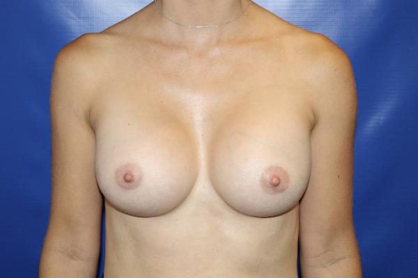after breast augmentation front view female patient case 4925