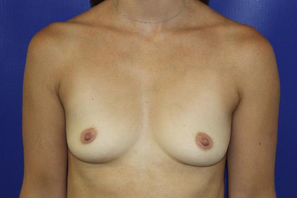 before breast augmentation front view female patient case 4925