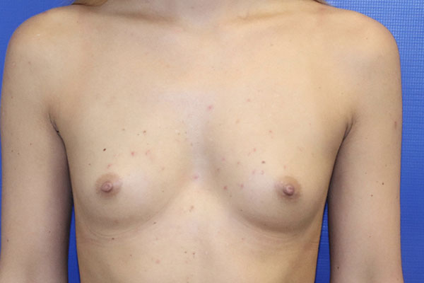 before breast augmentation front view female patient case 5405