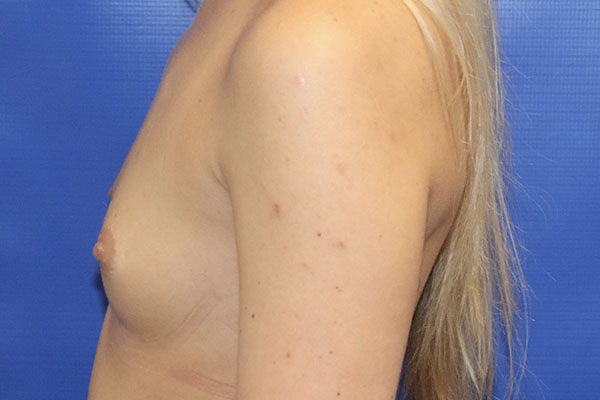 before breast augmentation left view female patient case 5405