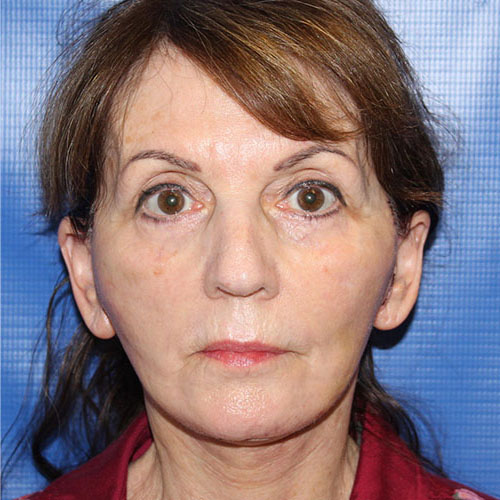 after facelift and neck lift front view female patient case 5427