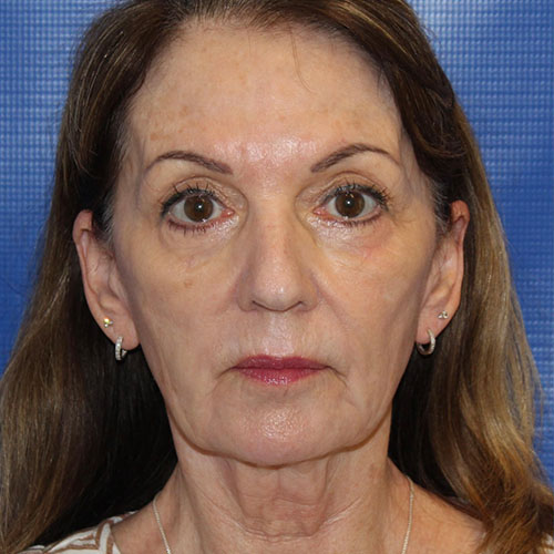 before facelift and neck lift front view female patient case 5427