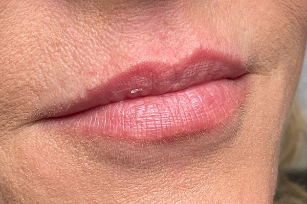 before filler closeup left view female patient case 5440