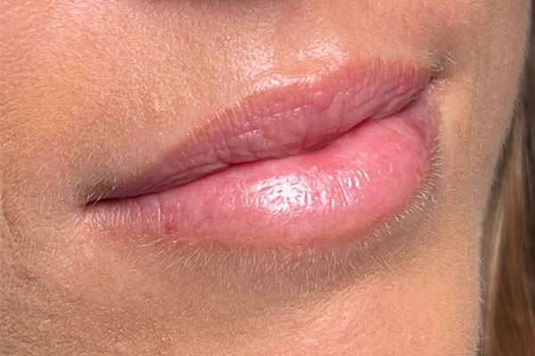 before filler closeup left view female patient case 5443