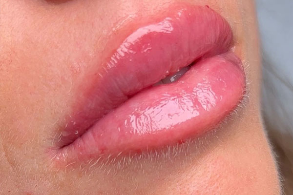 after filler closeup left view female patient case 5443