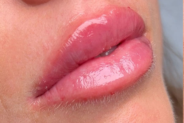 after filler closeup left view female patient case 5443