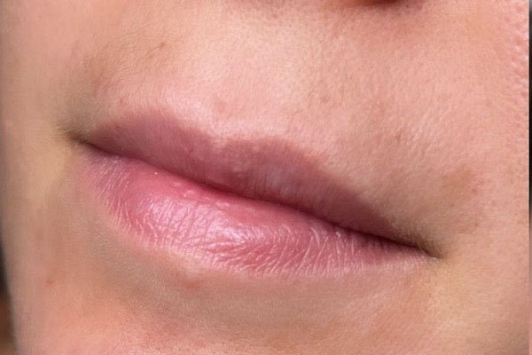 before filler closeup view female patient case 5448