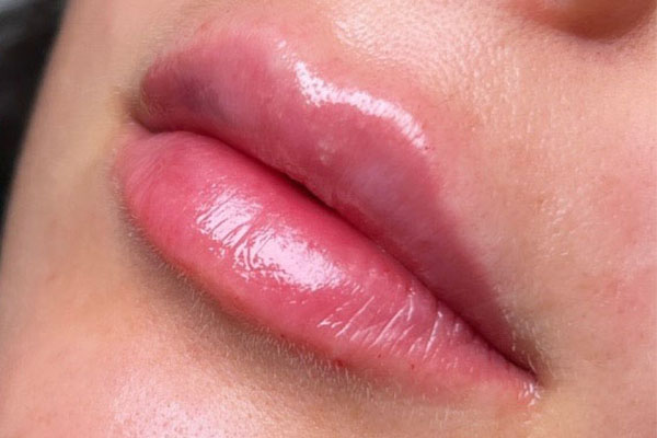 after filler closeup view female patient case 5448