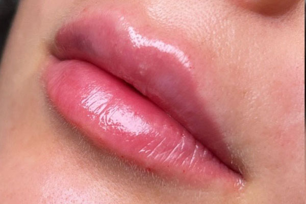 after filler closeup view female patient case 5448