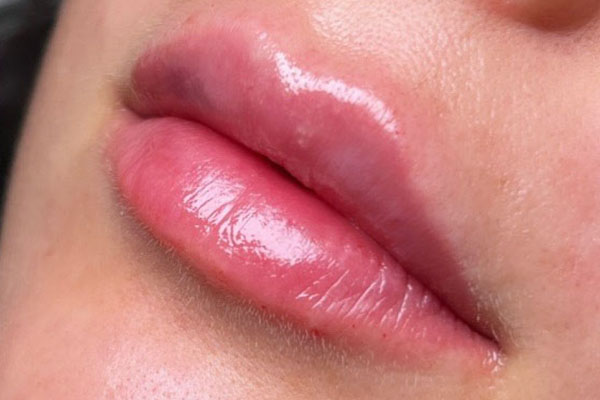 after filler closeup view female patient case 5448