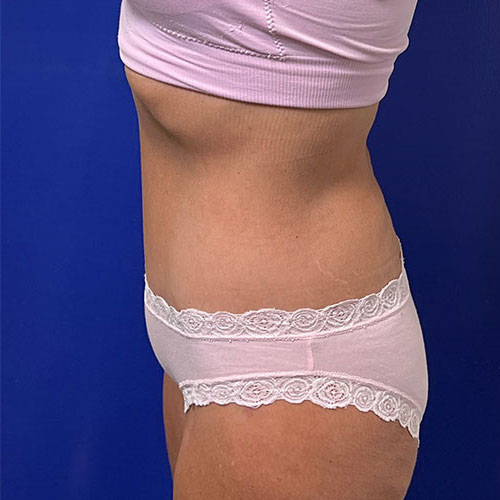 after halo lift left view female patient case 5453