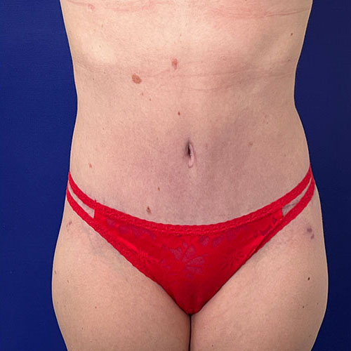 after halo lift front view female patient case 5458