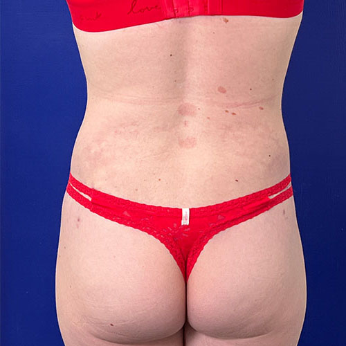 after halo lift back view female patient case 5458