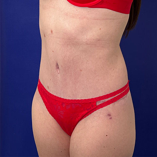 after halo lift left angle view female patient case 5458