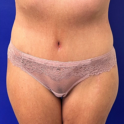 after halo lift front view female patient case 5467